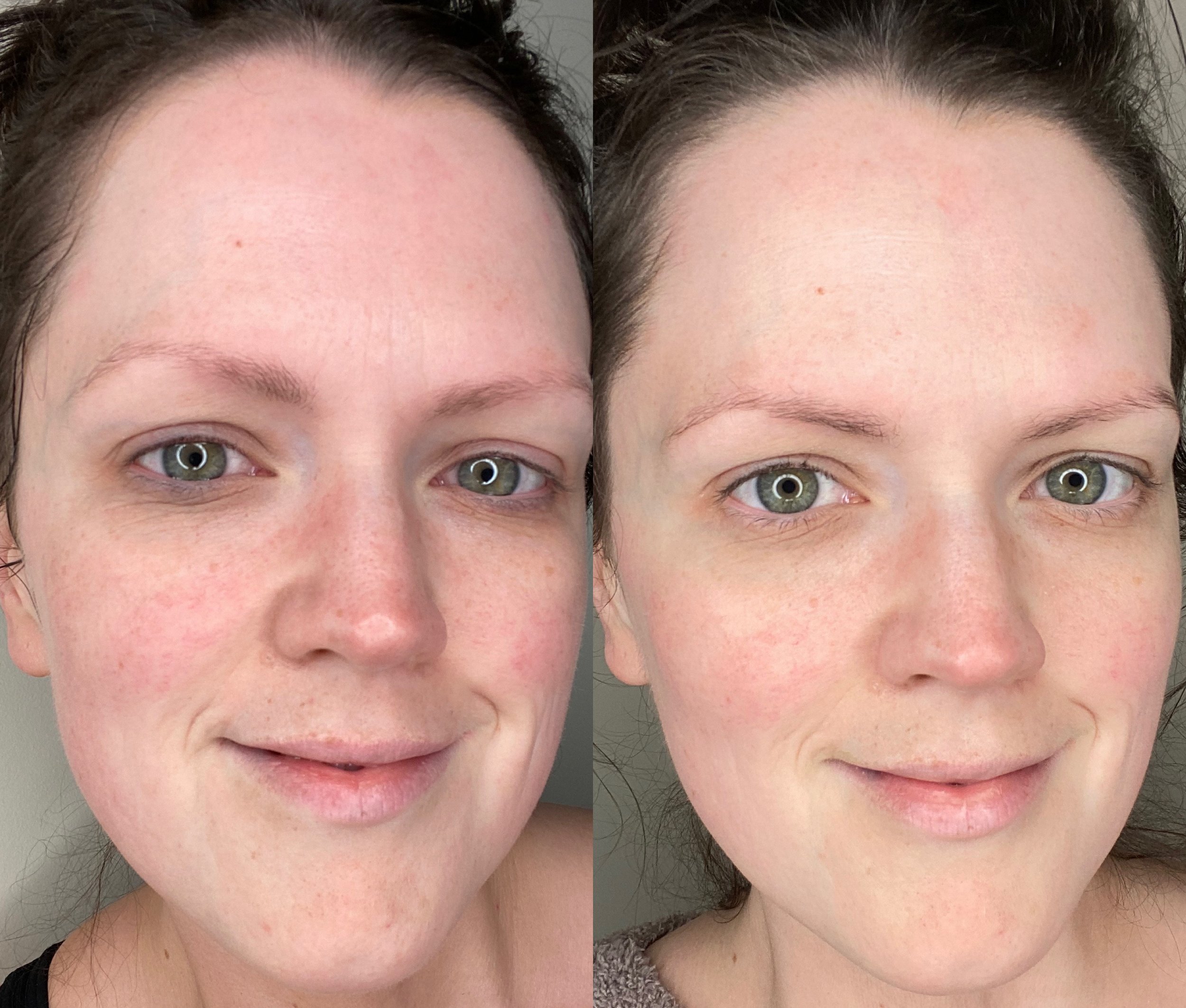 What is Anti-Aging Omnilux (Light)Therapy?